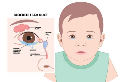 tear duct blockage in babies